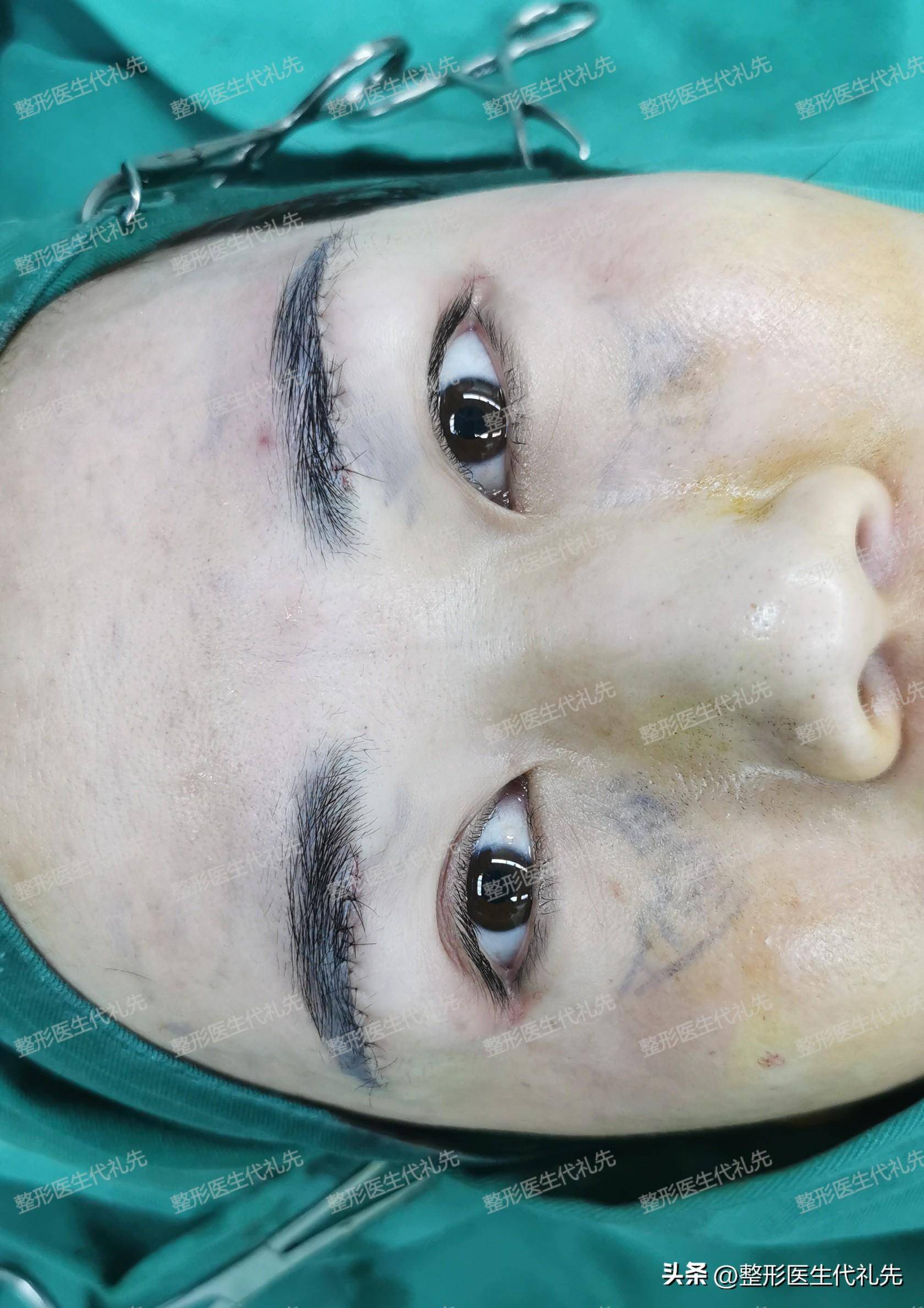 39岁女士做了眼周凹陷填充 筋膜悬吊提眉手术,术后一周拆线对比_脂肪
