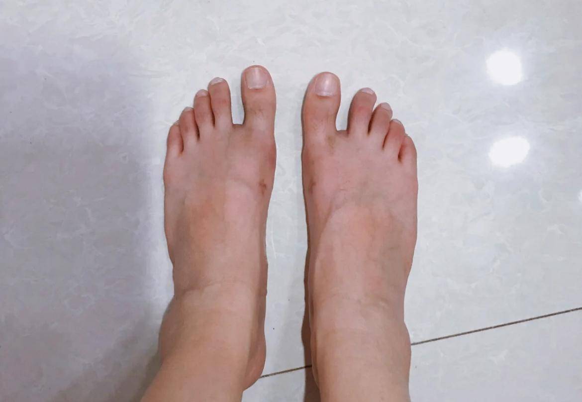就是脚趾缝有点大,因为之前歪斜的大脚趾把"老二"也顶偏了,早点干预