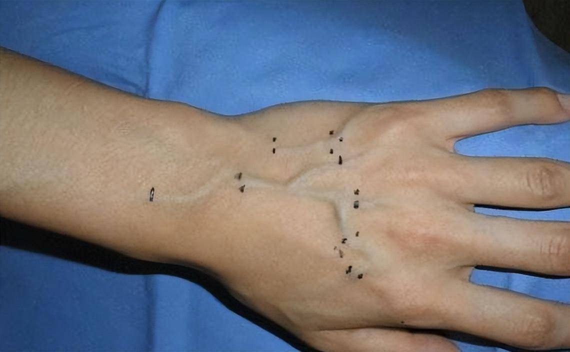 手背青筋越多,身体越差?医生告诉你真相_血管_运动_说法