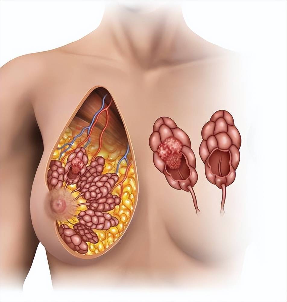 长有肺结节、乳腺结节或甲状腺结节,到底要不要切除呢？