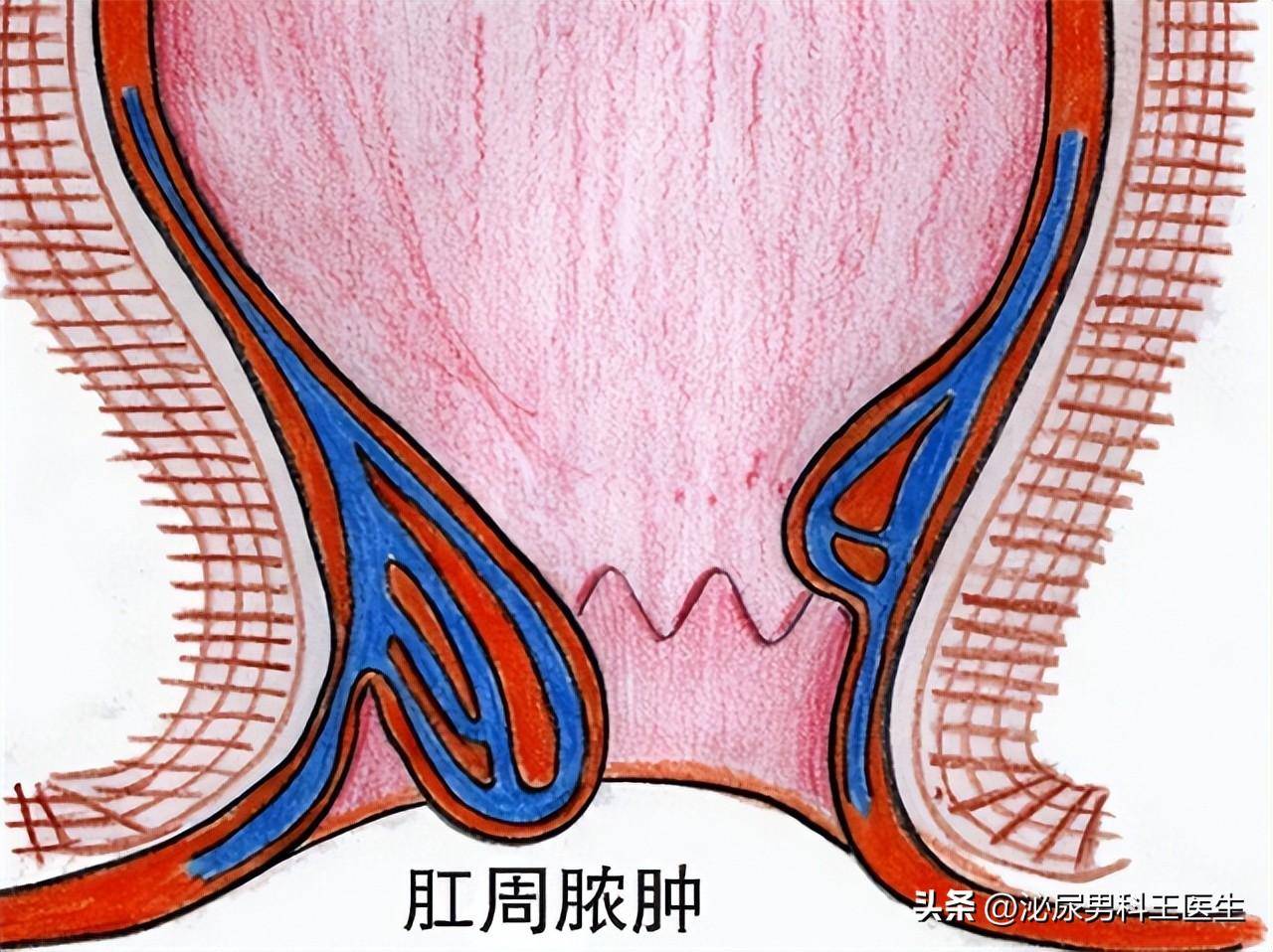 肛管癌痔疮图片