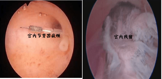 云浮市人民医院妇科开展门诊宫腔镜诊疗_检查_生殖_子宫