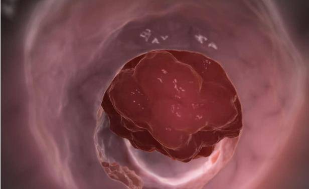癌粪先知, 排便出现3种异常情况,多半是肠癌缠身了