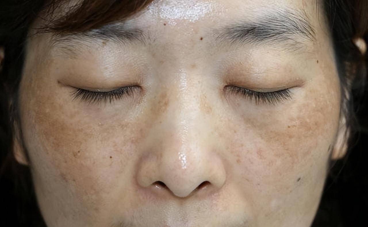 脸部的额头和下巴处出现黑色素沉淀人体的激素数值的稳定与身体内部的