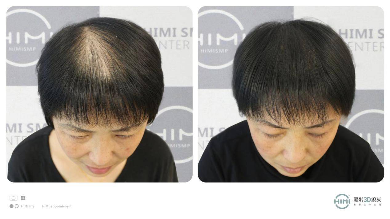 总体来说,纹发的群体还是偏男性,因为脱发人群占比