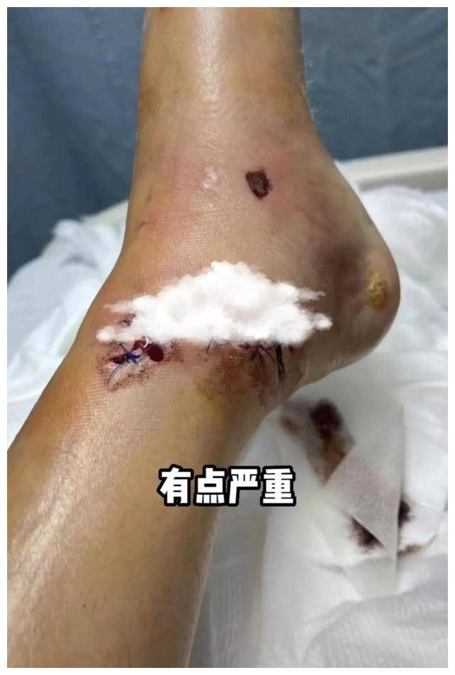 31岁陈学冬娱乐圈里最惨新人,出车祸腿部手术_因为_网友_娜娜