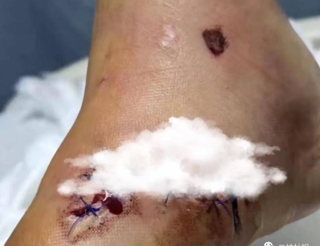 陈学冬出车祸,无法行走,还庆幸没有毁容