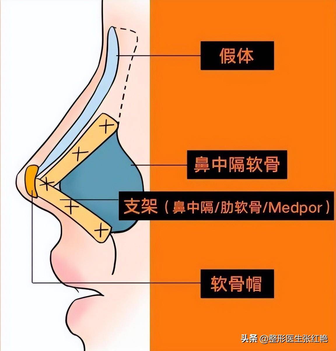 鼻综合鼻子_鼻子综合费用大概多少钱_鼻子综合贵吗