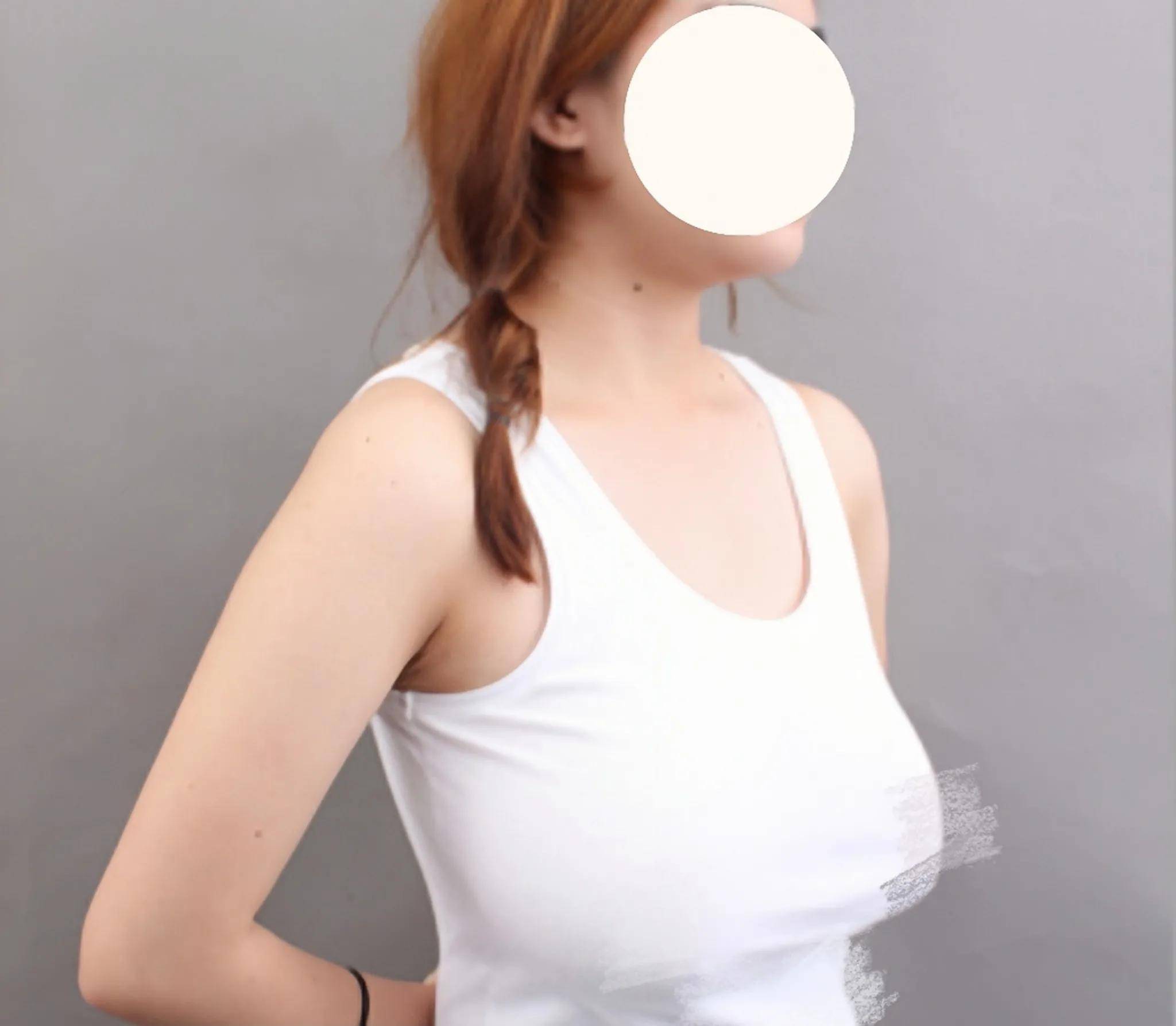 26岁胸部肥大,下垂接近肚脐,到北京"缩胸上提"后感慨真值!