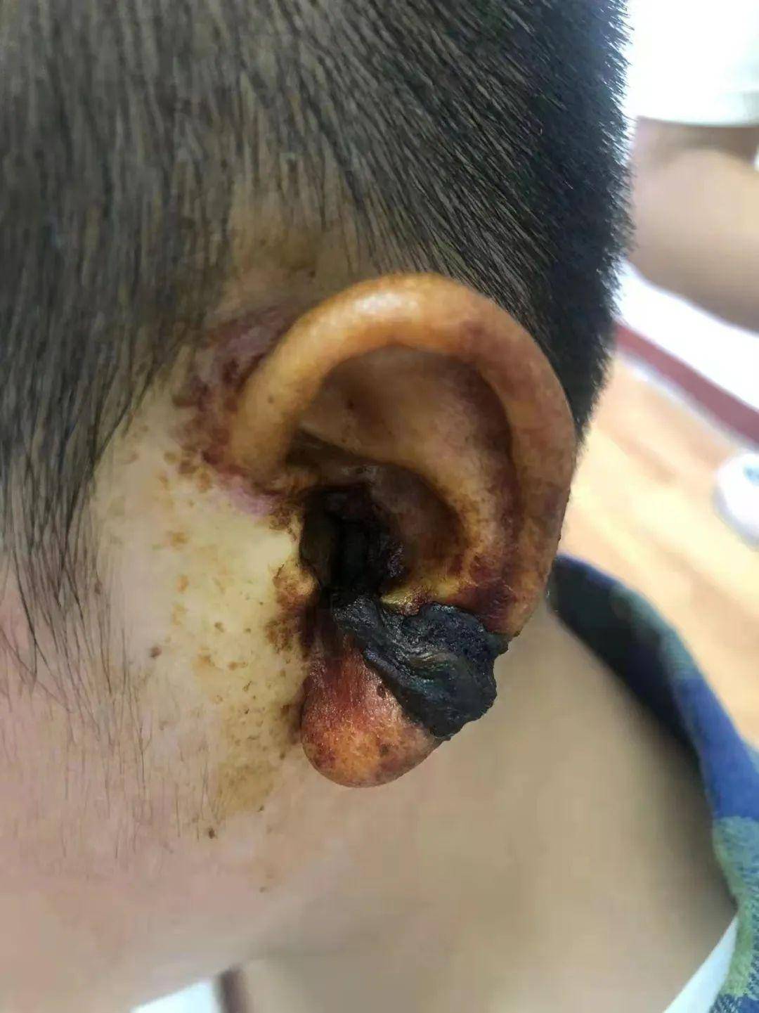 技术,屏住呼吸,聚精会神,犹如刺绣大师一样精准操作,一针一针进行缝合
