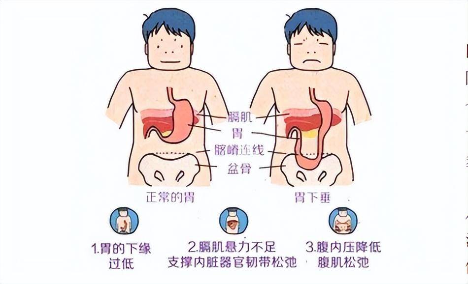 胃的位置就會相對下降,而醫學上所說的胃下垂,通常是指胃大彎抵達盆腔