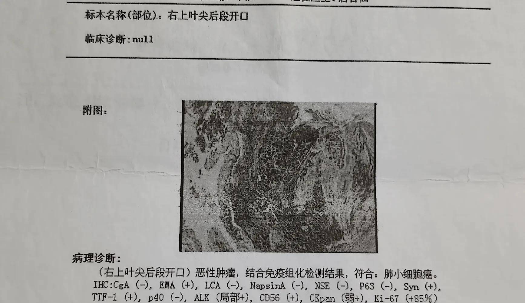 肺癌病理诊断报告单图片