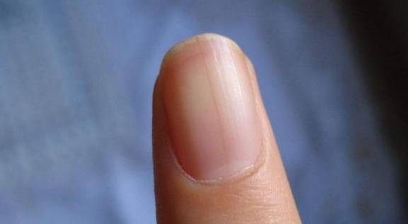 手指甲出现"竖纹"?可能是这4个原因造成的,不妨看看_身体_情况_现象