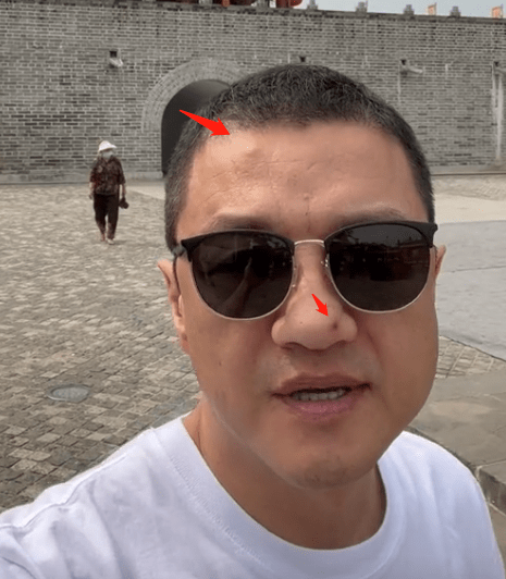 李亚鹏赚钱急上火,牙肿脸变形严重爆俩痘,莲雾枇杷都认错还科普_视频