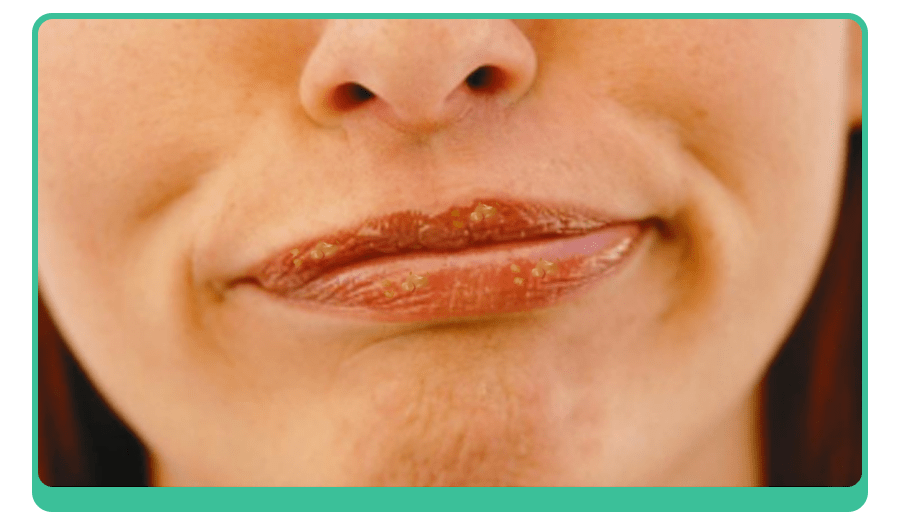 急性唇炎是什么原因引起的 如何预防？