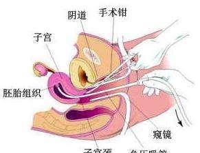 深度揭秘（假怀孕被发现装流产）假装怀孕生宝宝 第4张