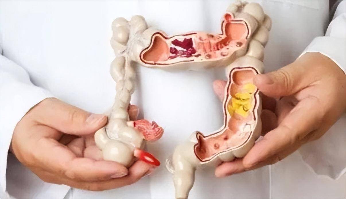 大便总感觉"拉不干净"?