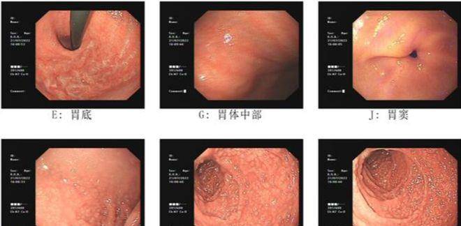 慢性萎縮性胃炎o3;十二指腸多發粘膜顆粒樣隆起 性質待病理;61胃鏡