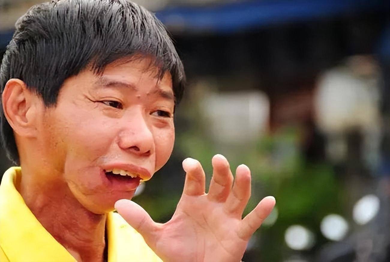 长期吃槟榔会有什么危害?_口腔_黏膜_小孩