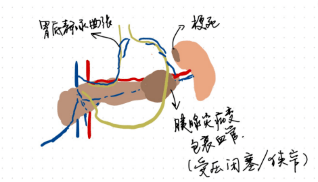 以及出现胃底侧枝循环形成,血栓形成或继发于脾动脉受累的脾梗死等