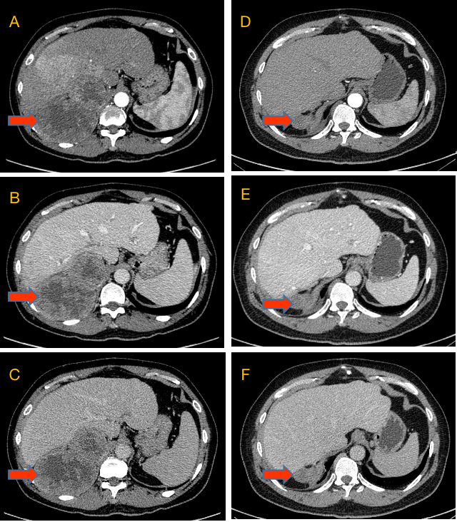 复发率高达70%,这个疗法降低肝癌术后复发率