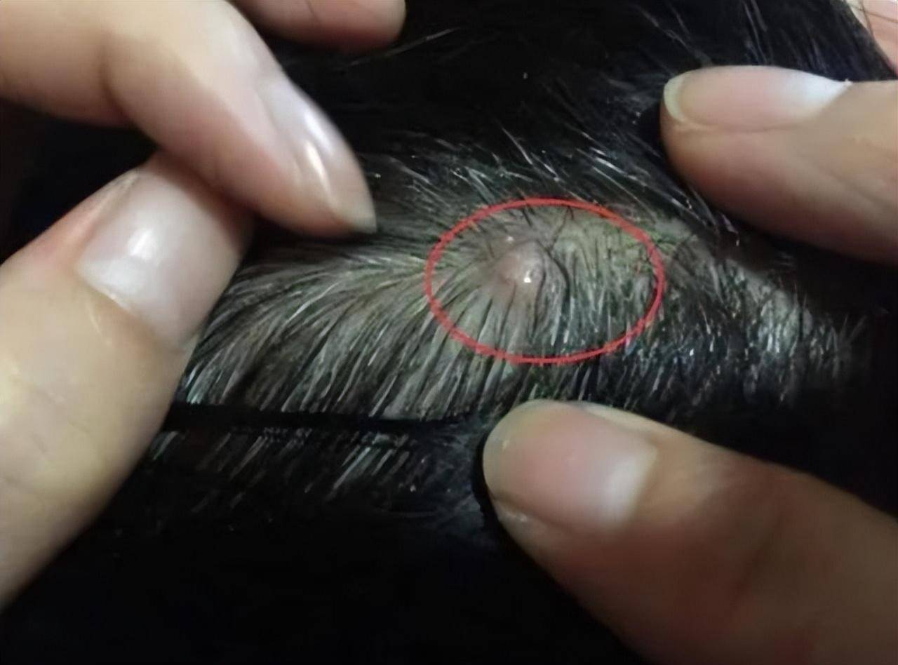 医生提示:3种病或要考虑在内_表面_头部_头发