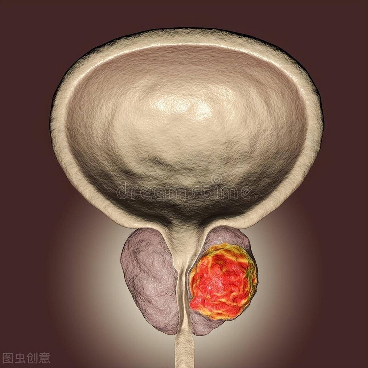 这些炎症尚未治愈,会使男性前列腺组织充血,进而导致前列腺肥大