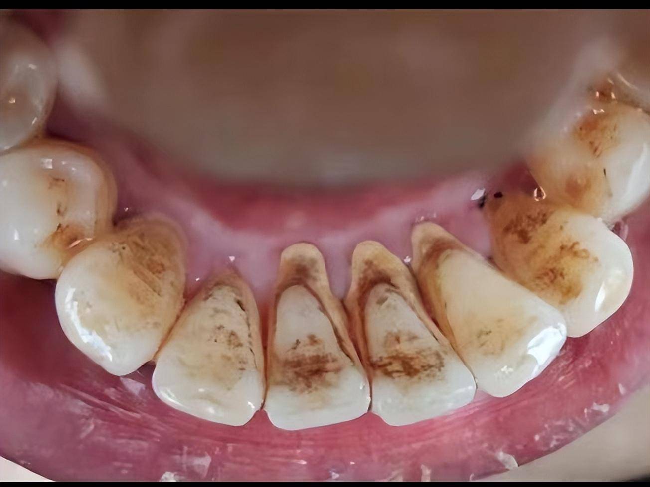 用到第三盒的时候,牙齿内侧还有牙缝里的烟渍就彻底的被清除干净,而且