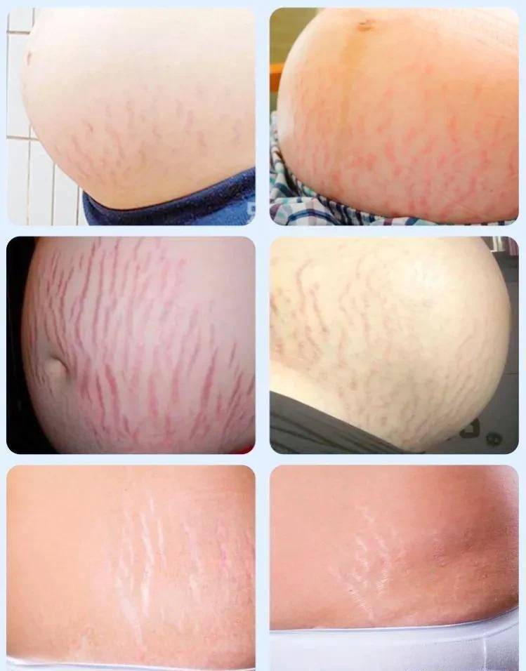 孕肚中间有一条明显的黑线,将孕肚一分为二,让本就吓人的孕肚更加难看