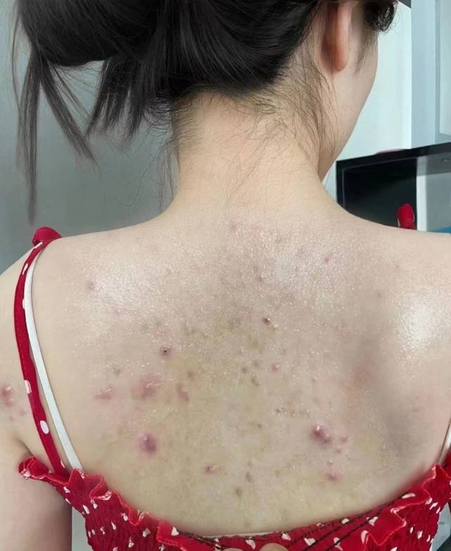 也不知道怎么整得沾染了螨虫,导致我后背长了可多痘痘,天气越热身上出