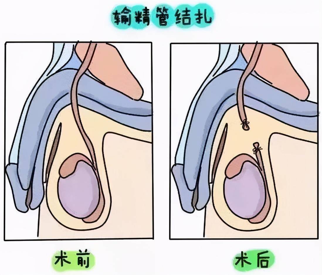 不剪断输精管的结扎图片