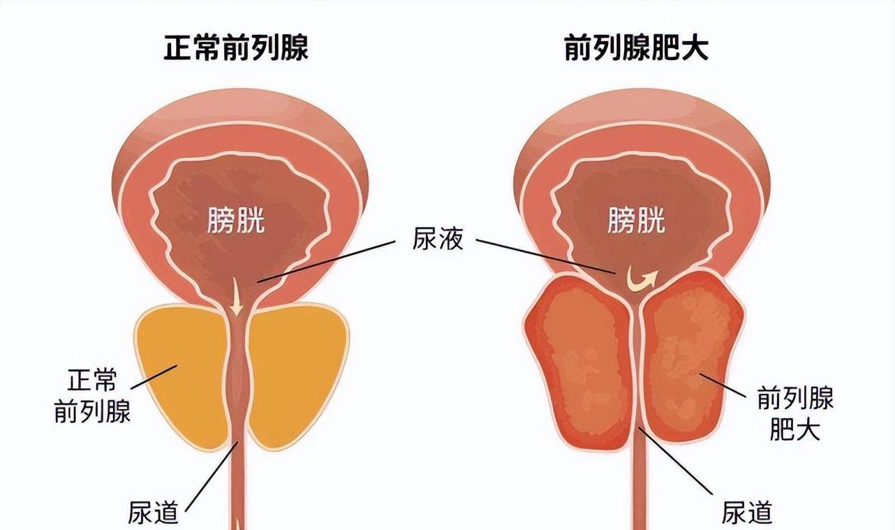 前列腺的位置示意图图片