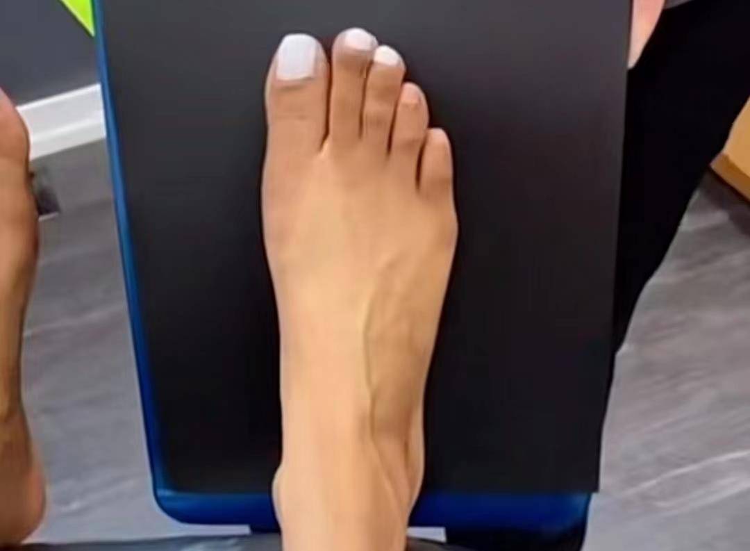 辽宁50岁女患者天生"怪脚"老公带着做微创手术后"逆袭"_医生_大拇指