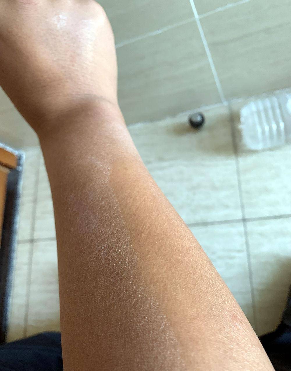 小腿皮肤开裂,是鱼鳞病吗?要不要看医生?_针对性_肌肤_地方