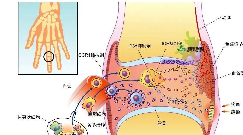 类风湿性关节炎病因,发病机制与临床概述_患者_风险_细胞