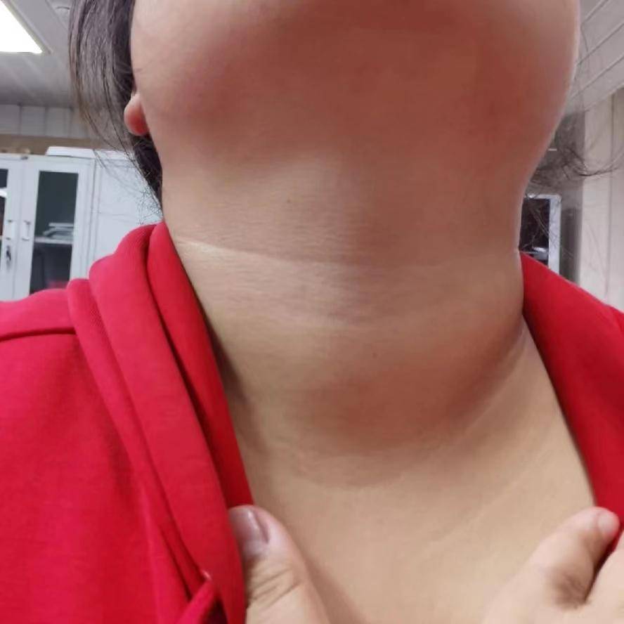脖子肿大 来自搜狐网