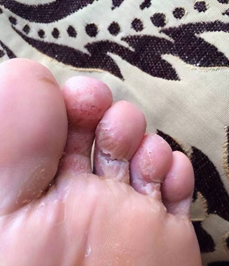 脚底瘙痒,水泡成片长?过来人教你一招,在家给脚气"断根"!