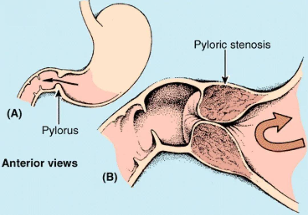 医考知识点总结 先天性肥厚性幽门狭窄的临床表现