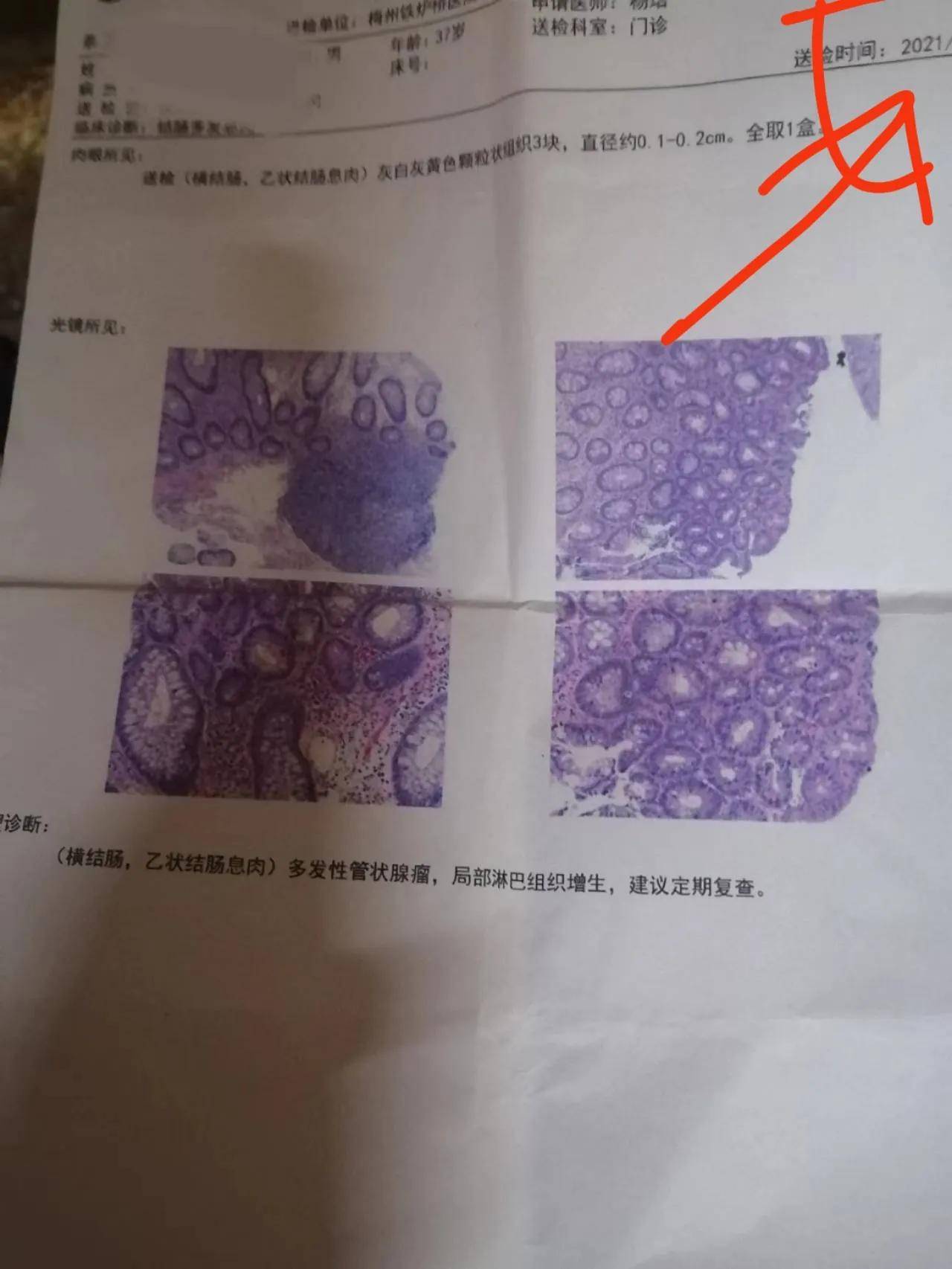 多发性肠道息肉,终于不再长了…_复查_问题_脾胃