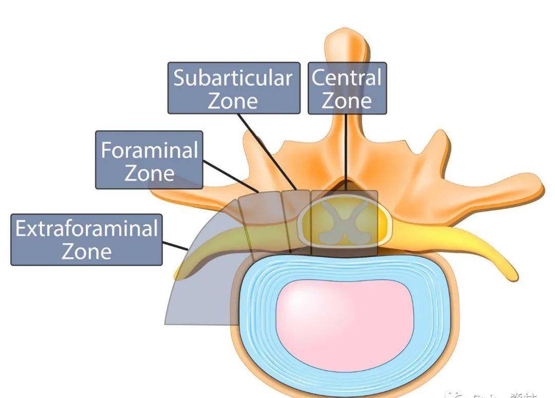 椎间孔侧隐窝图片