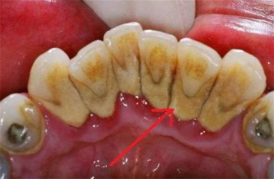 禁止用手去抠牙结石!过来人的无偿分享,居家刷牙就能清除牙结石!