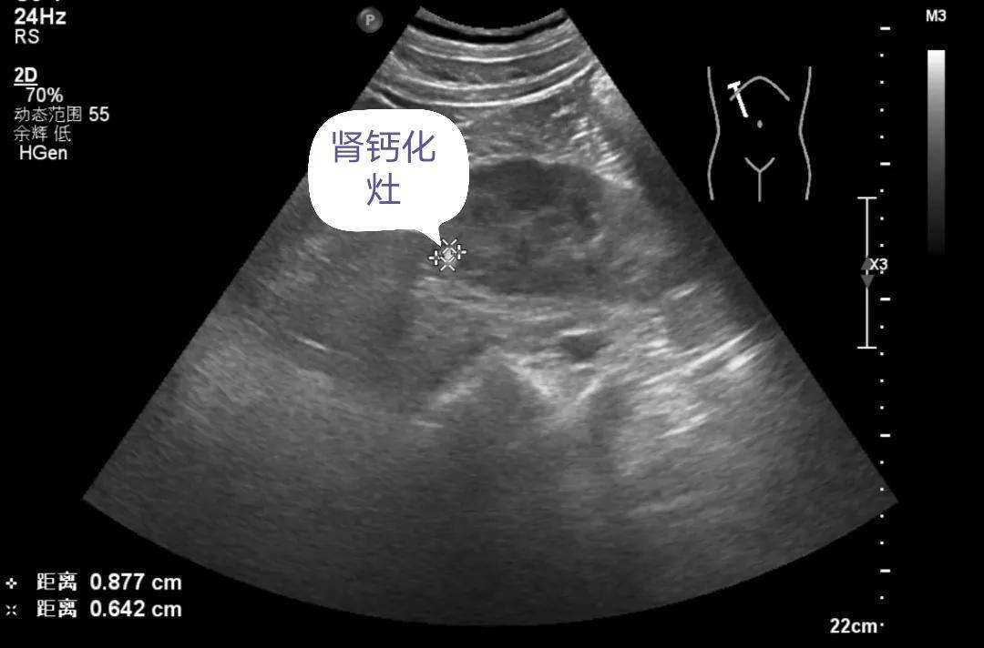 解读肾脏超声检查报告 肾结石