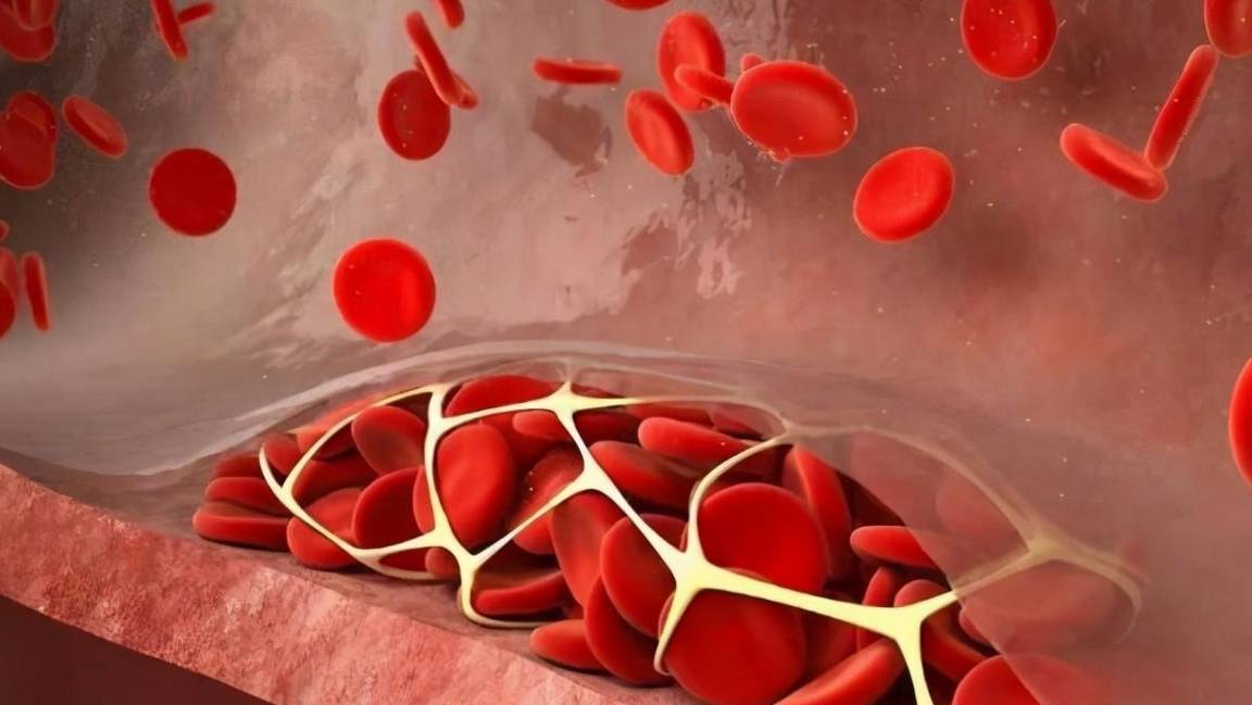 糖尿病多种并发症,根源在微循环障碍,扩张血管抗血栓怎么治疗_刘先生