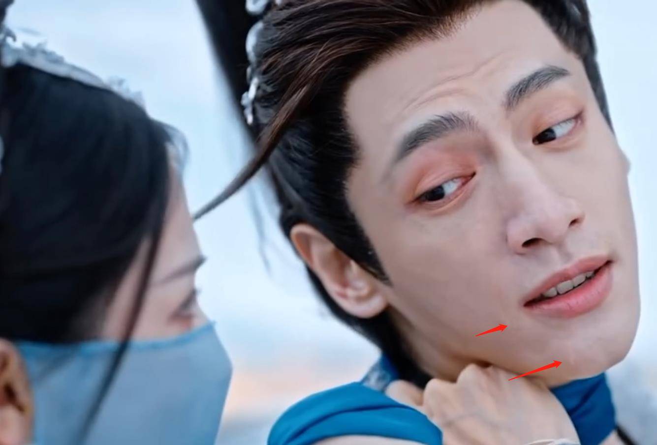 罗云熙疤痕显露!