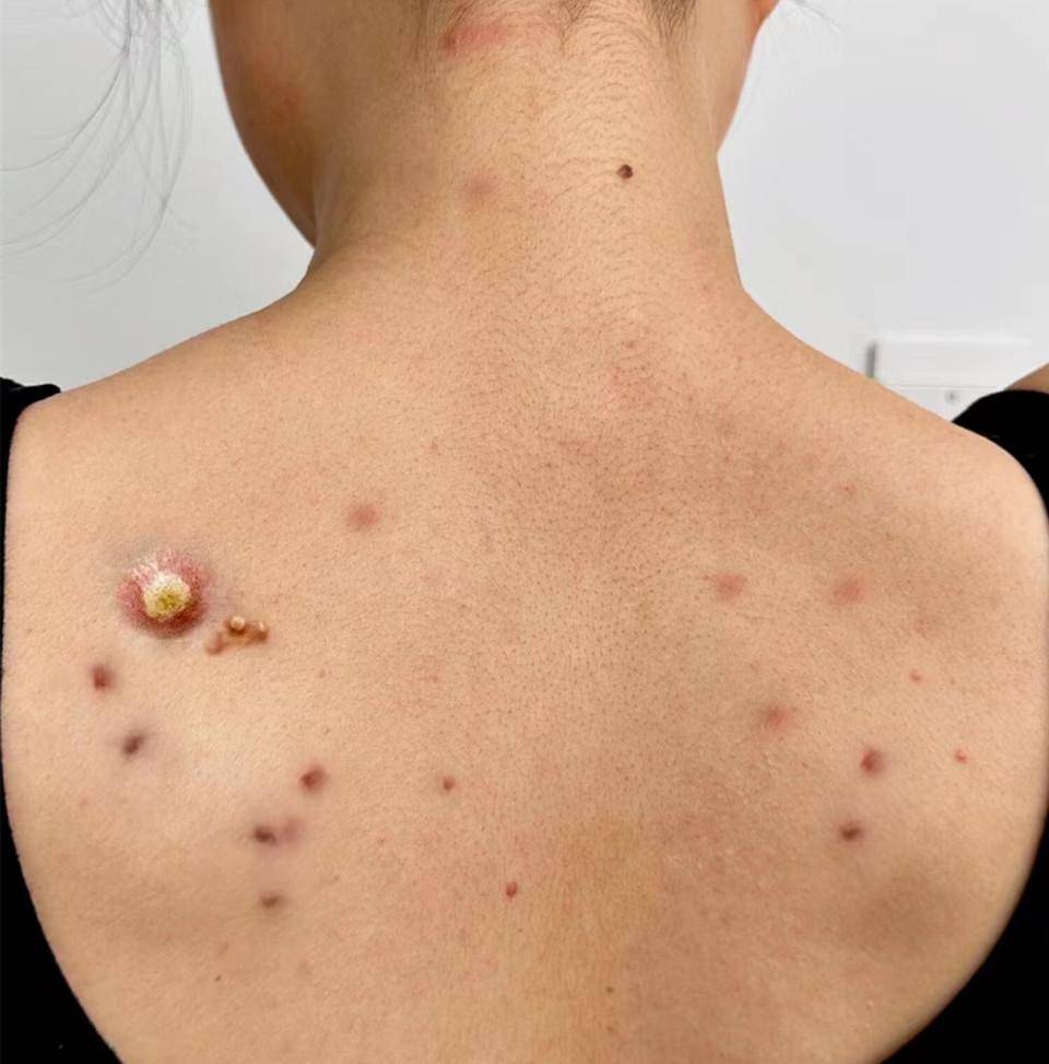 痘痘粉刺满背都是!一定是螨虫在搞鬼!支你一招,彻底解决螨虫痘!