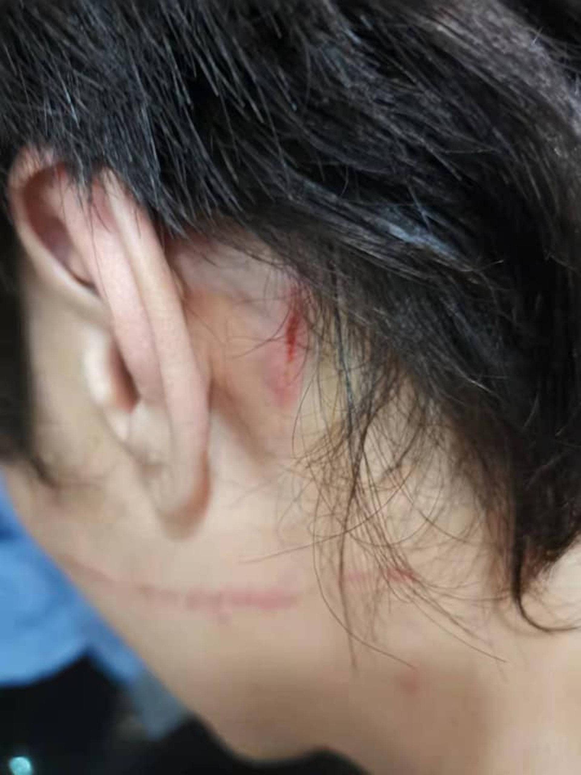38岁香港歌手被曝遭妻子家暴,头部受伤见血,曾家暴前妻不获同情