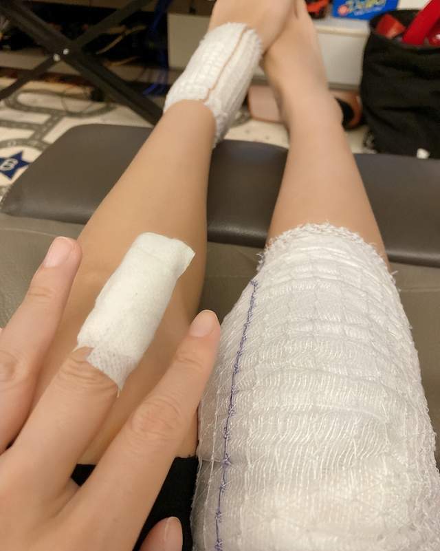 当时,她的脚踝,膝盖和手指都被纱布包扎着.