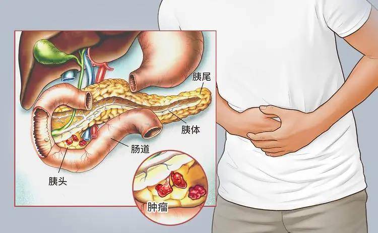 每天大便两三次,确诊胰腺癌!