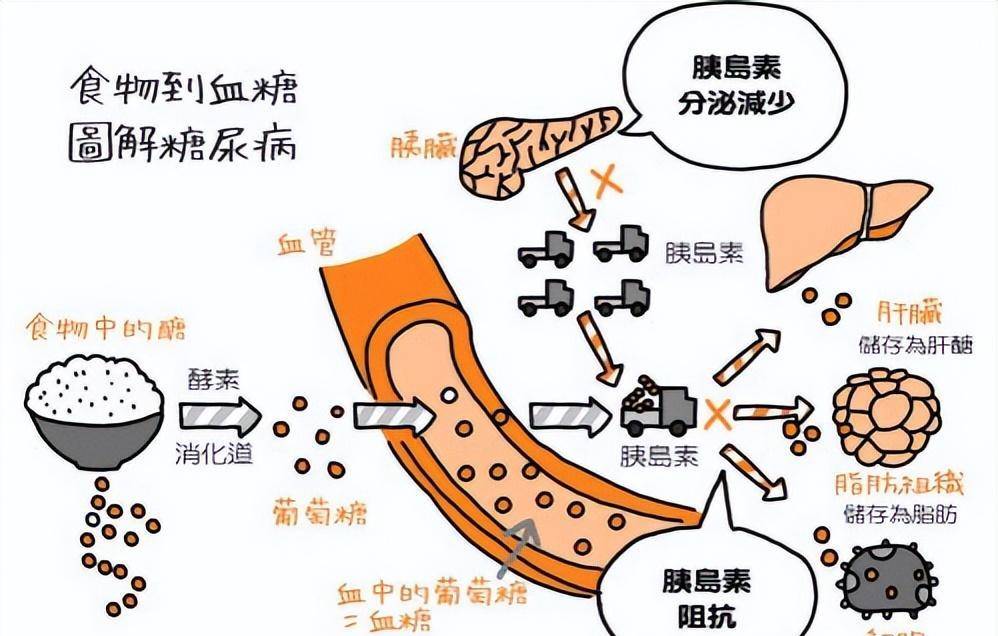 52岁女子左腿无力伸不直,医生提醒:这是糖尿病并发症的信号