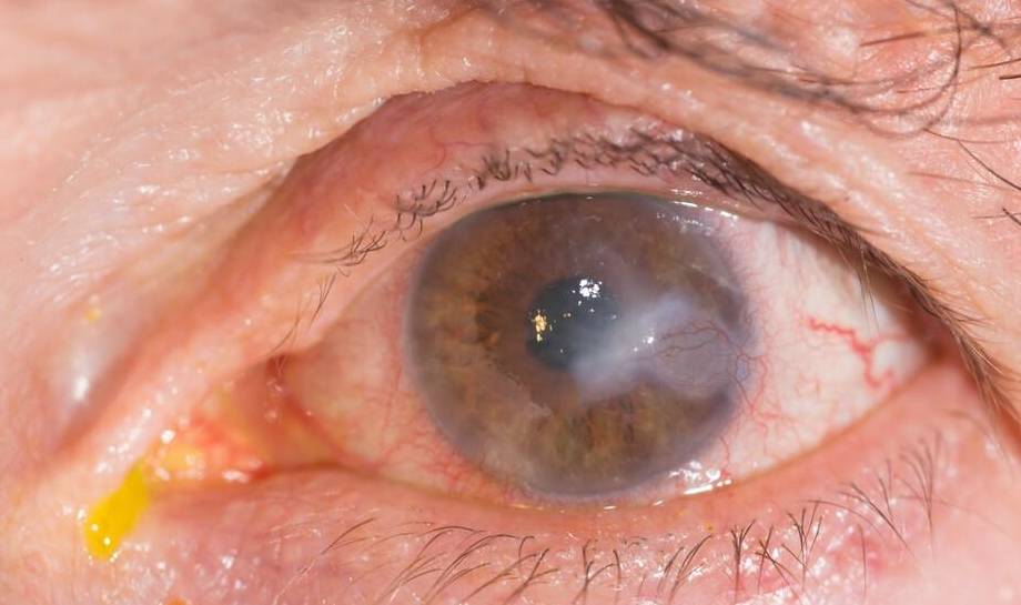 而风湿相关性边缘性角膜病变,蚕食性角膜溃疡是由于风湿病或其他免疫